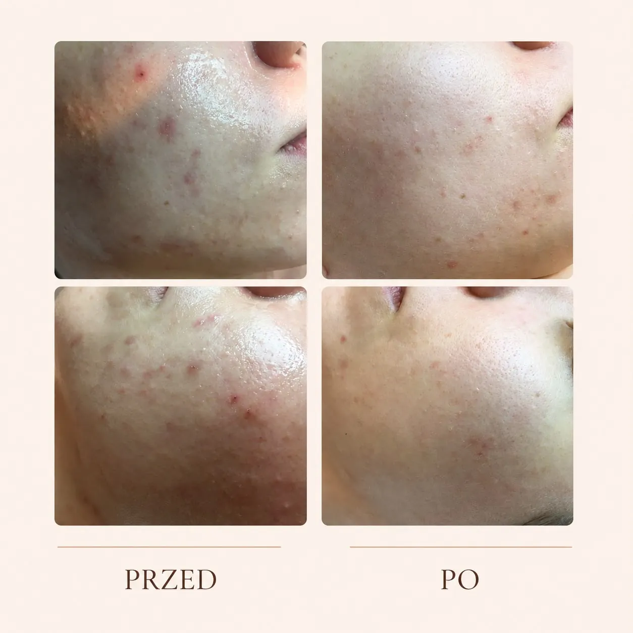 Efekt zabiegu S-Peel - salicylowy, pirogronowy, retinol - zdjęcie przed i po